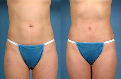 Liposuction for Women Before & After Gallery - Patient 416337 - Image 1
