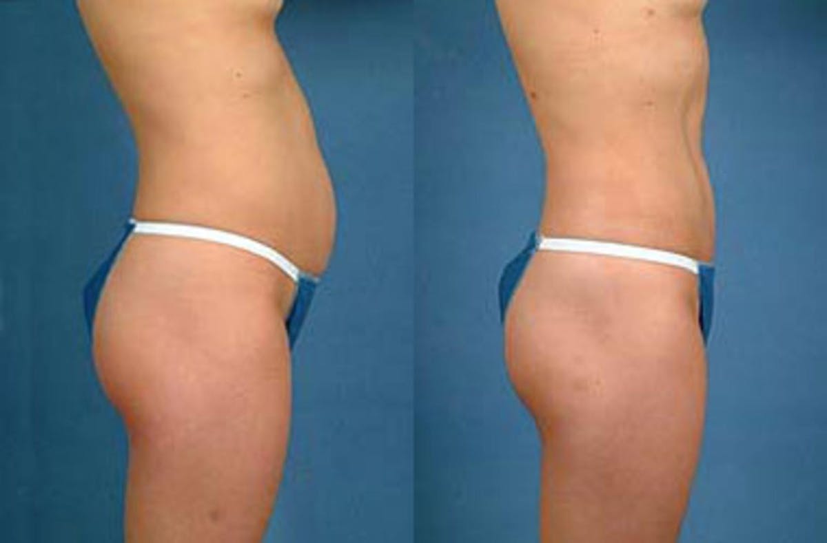 Liposuction for Women Before & After Gallery - Patient 416337 - Image 2