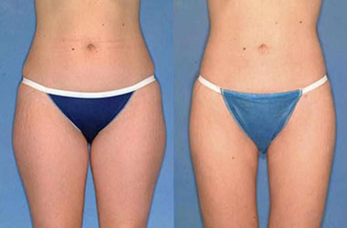 Liposuction for Women Before & After Gallery - Patient 244936 - Image 1