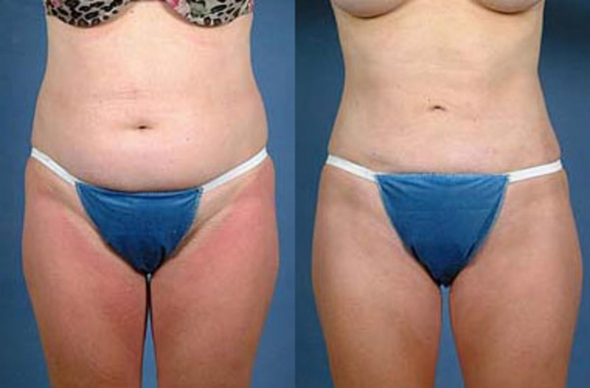 Liposuction for Women Before & After Gallery - Patient 217488 - Image 1
