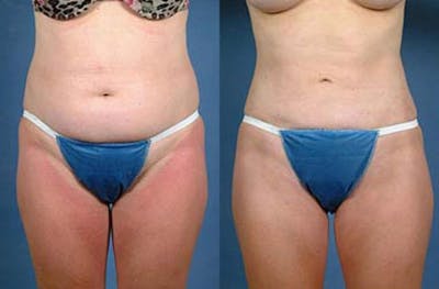 Liposuction for Women Before & After Gallery - Patient 217488 - Image 1