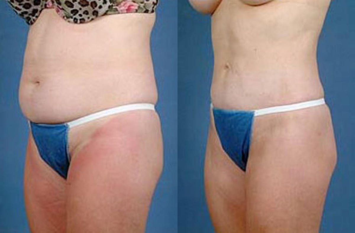 Liposuction for Women Before & After Gallery - Patient 217488 - Image 2