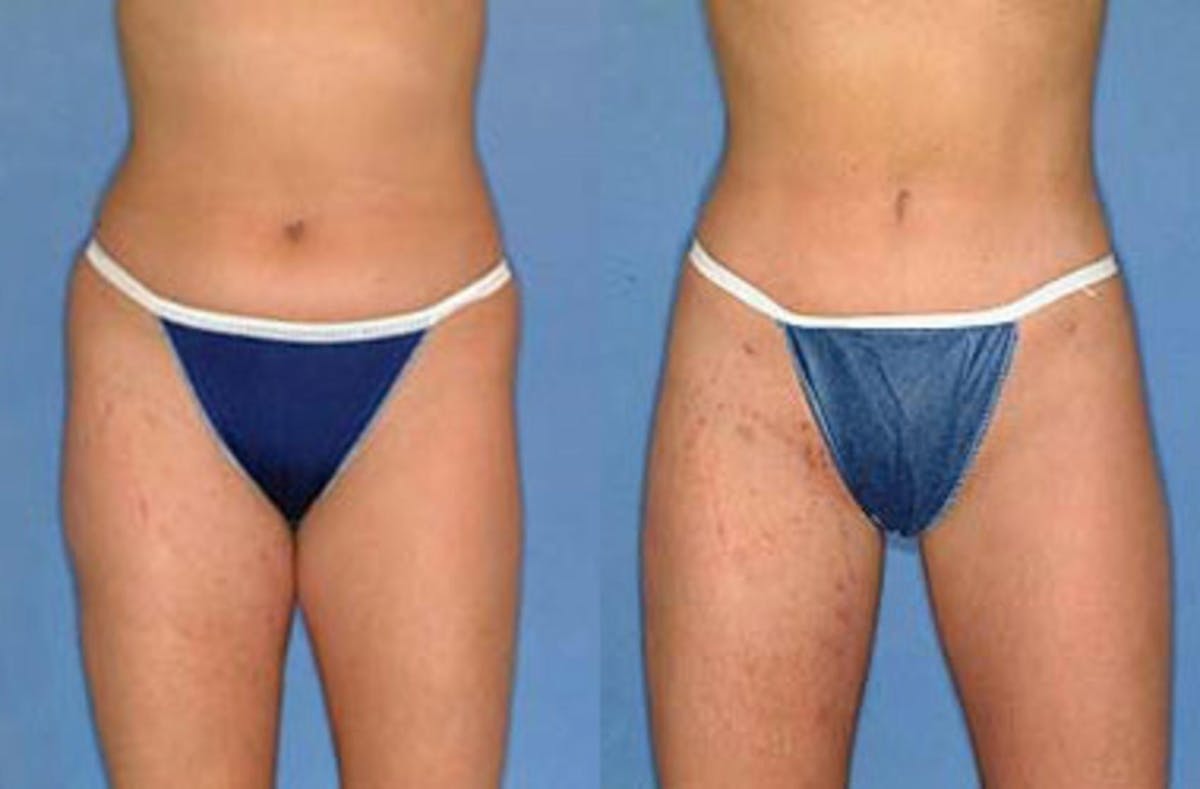 Liposuction for Women Before & After Gallery - Patient 356575 - Image 1