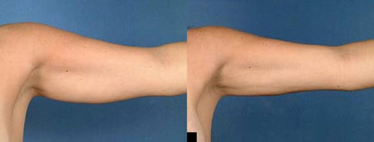 Liposuction for Women Before & After Gallery - Patient 122323 - Image 2