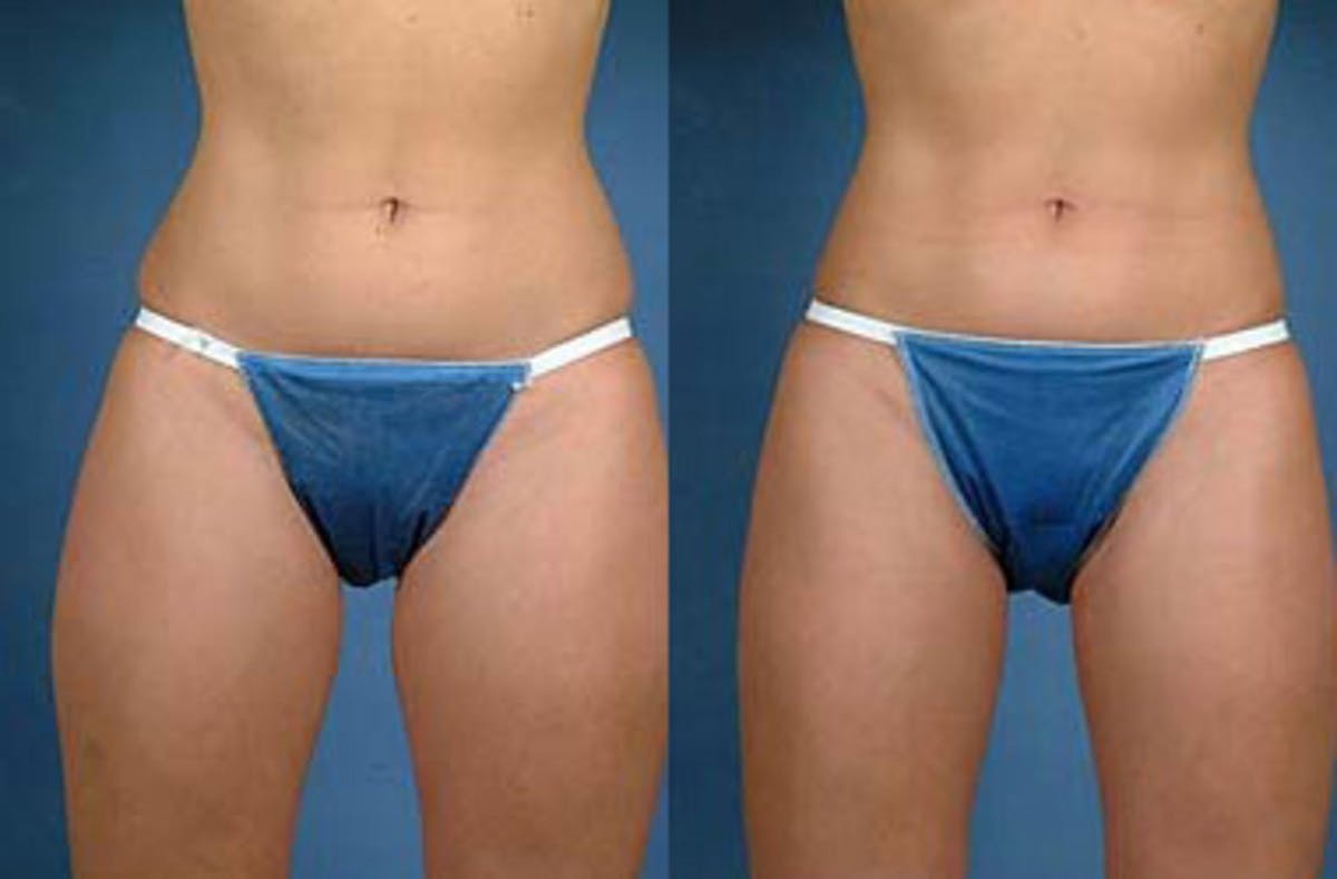Liposuction for Women Before & After Gallery - Patient 112363 - Image 1