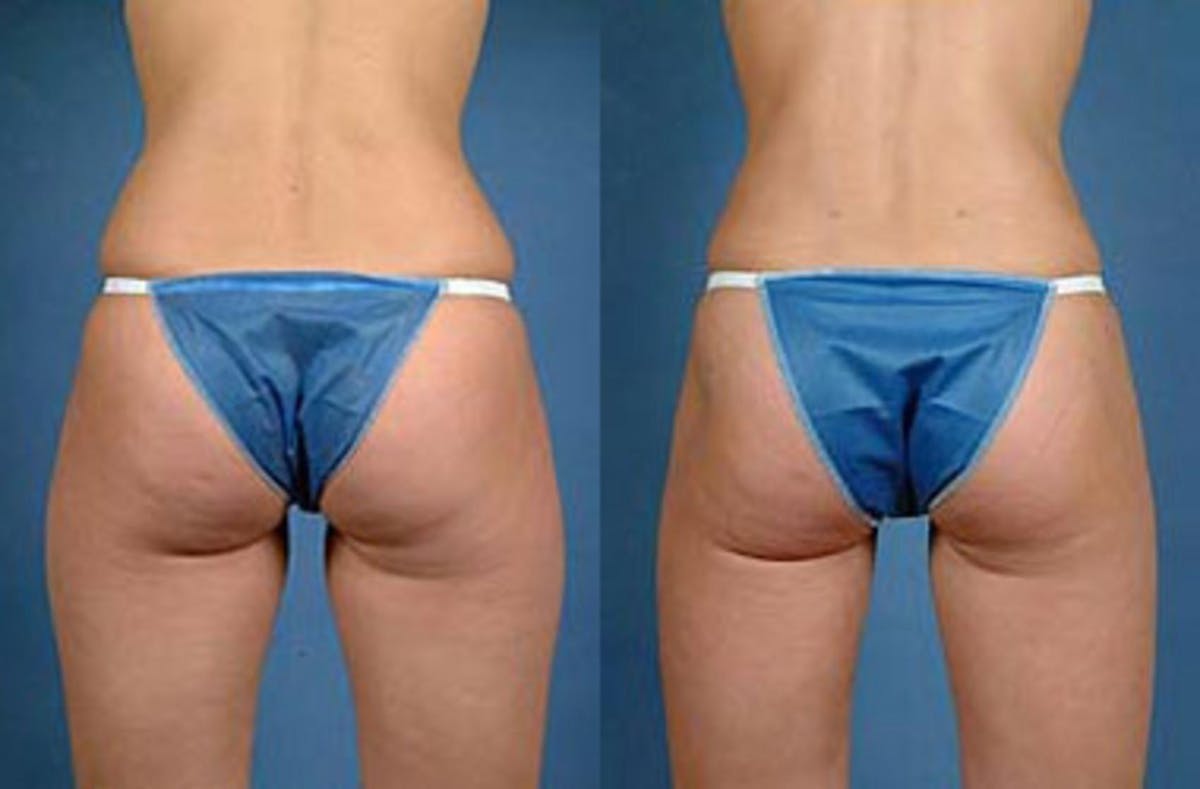 Liposuction for Women Before & After Gallery - Patient 112363 - Image 2