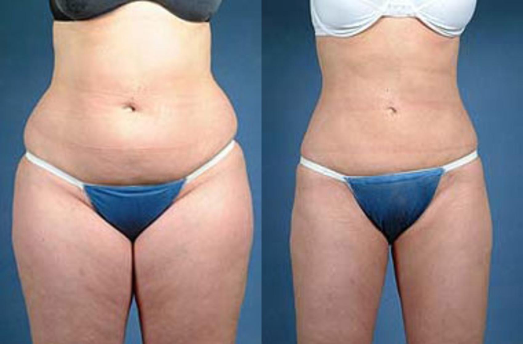 liposuction results