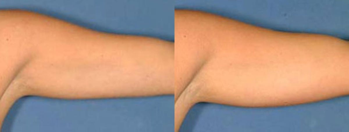 Liposuction for Women Before & After Gallery - Patient 609345 - Image 2