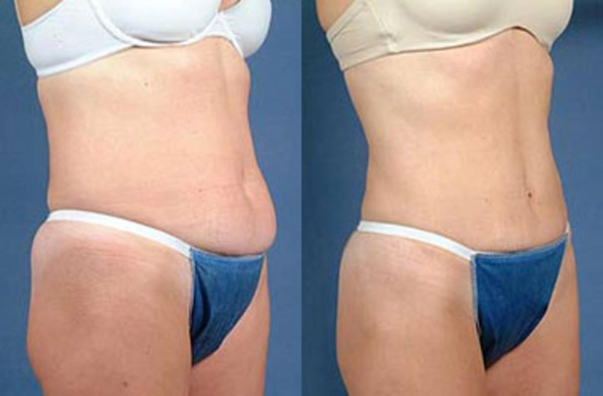 Liposuction for Women Before & After Gallery - Patient 342924 - Image 2