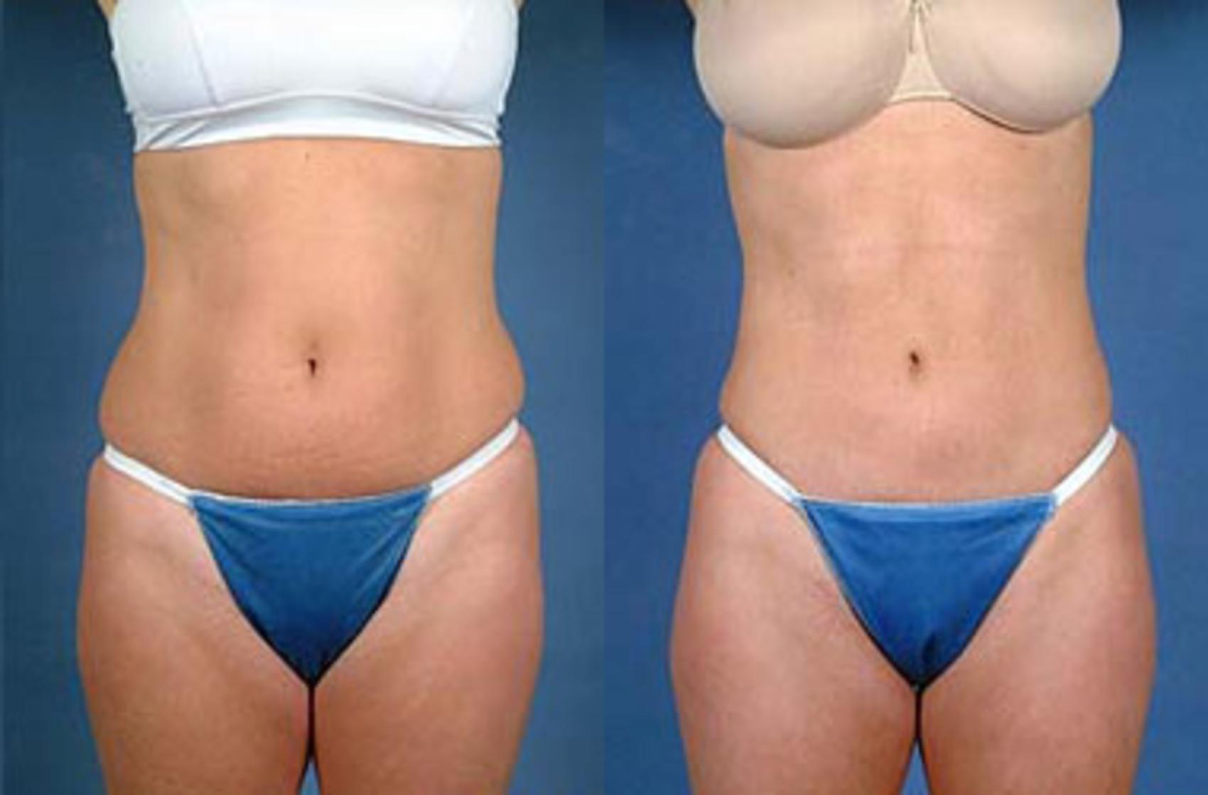 liposuction patient results