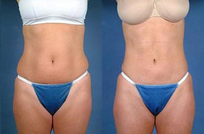 Liposuction for Women Before & After Gallery - Patient 232402 - Image 1