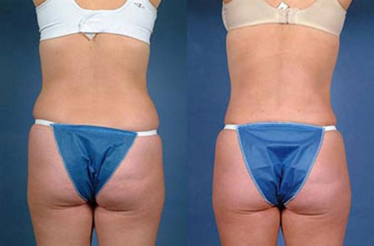 Liposuction for Women Before & After Gallery - Patient 232402 - Image 2