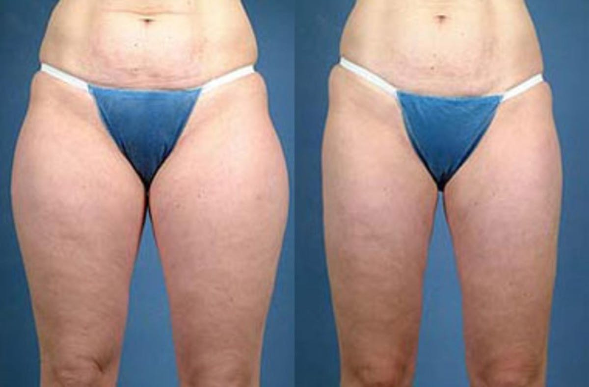 Liposuction for Women Before & After Gallery - Patient 201783 - Image 1