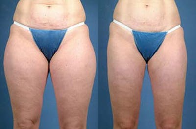 Liposuction for Women Before & After Gallery - Patient 201783 - Image 1