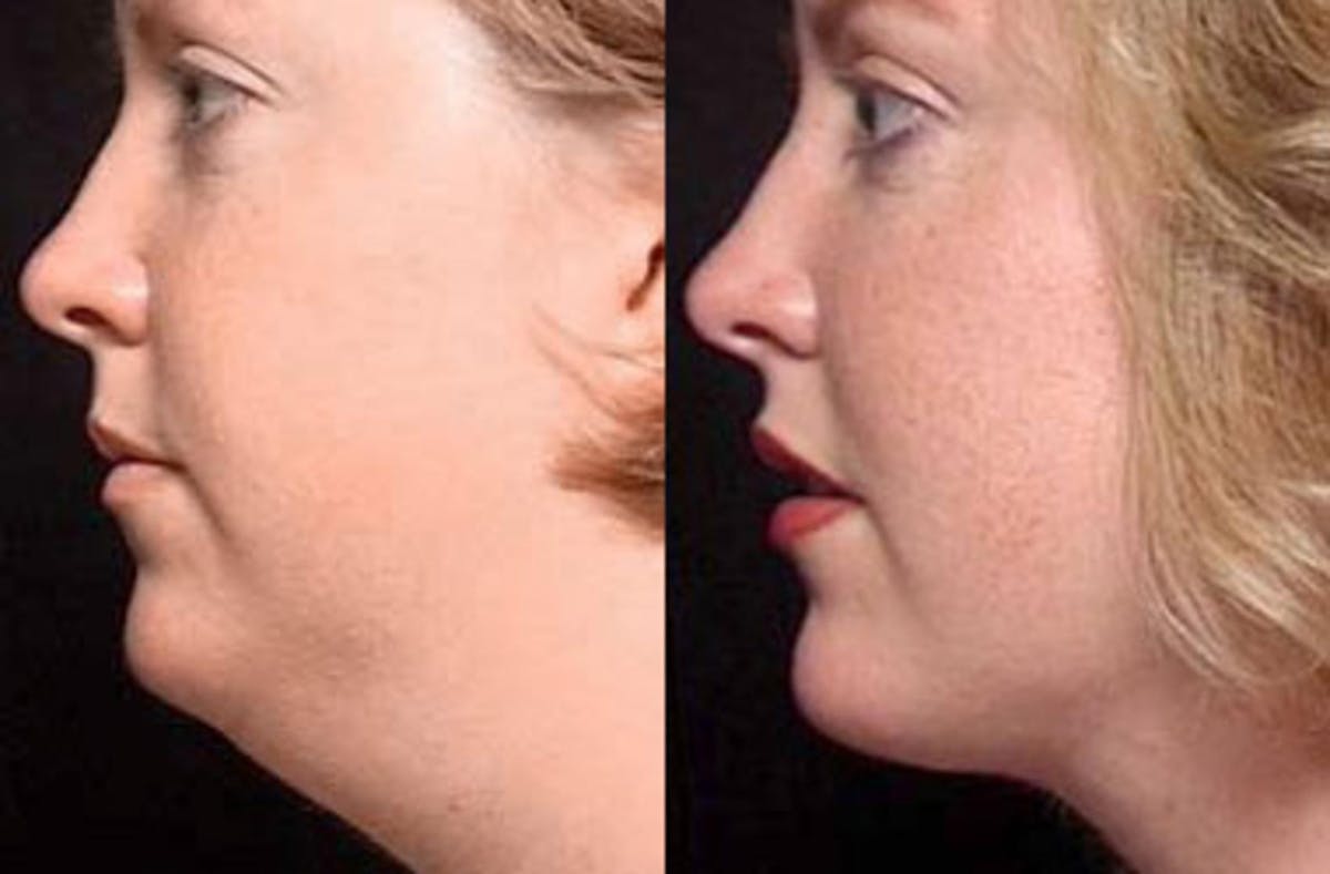 Neck Procedures Before & After Gallery - Patient 122098 - Image 2
