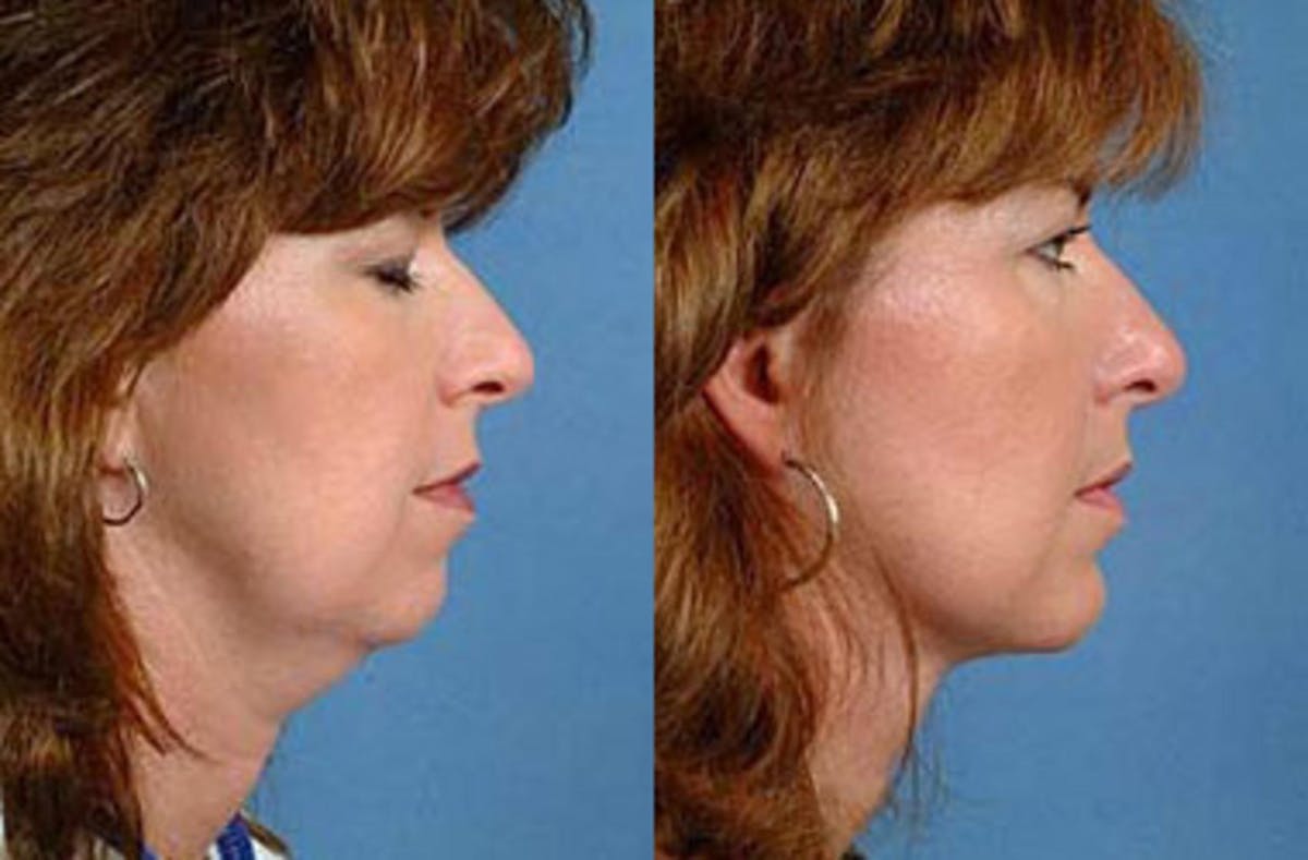 Neck Procedures Before & After Gallery - Patient 119718 - Image 1
