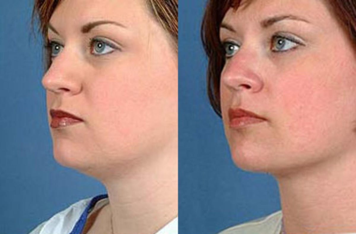 Neck Procedures Before & After Gallery - Patient 106506 - Image 1