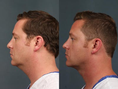 Neck Lift Before & After Gallery - Patient 645510 - Image 1