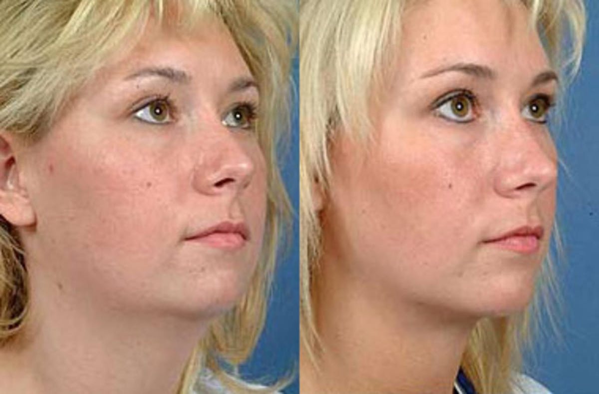 Neck Procedures Before & After Gallery - Patient 406513 - Image 1