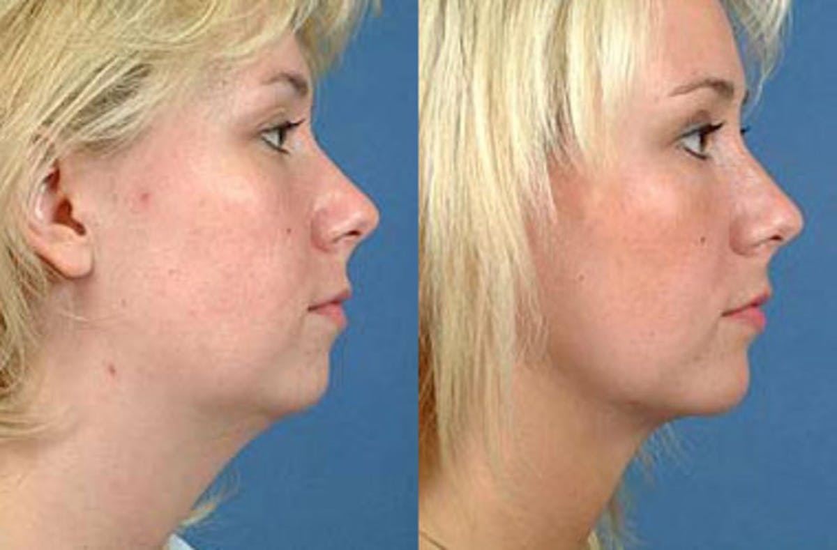 Neck Procedures Before & After Gallery - Patient 406513 - Image 2