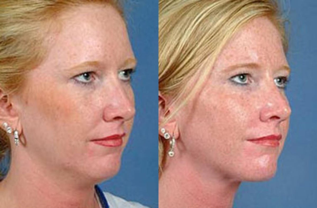 Neck Procedures Before & After Gallery - Patient 326242 - Image 1