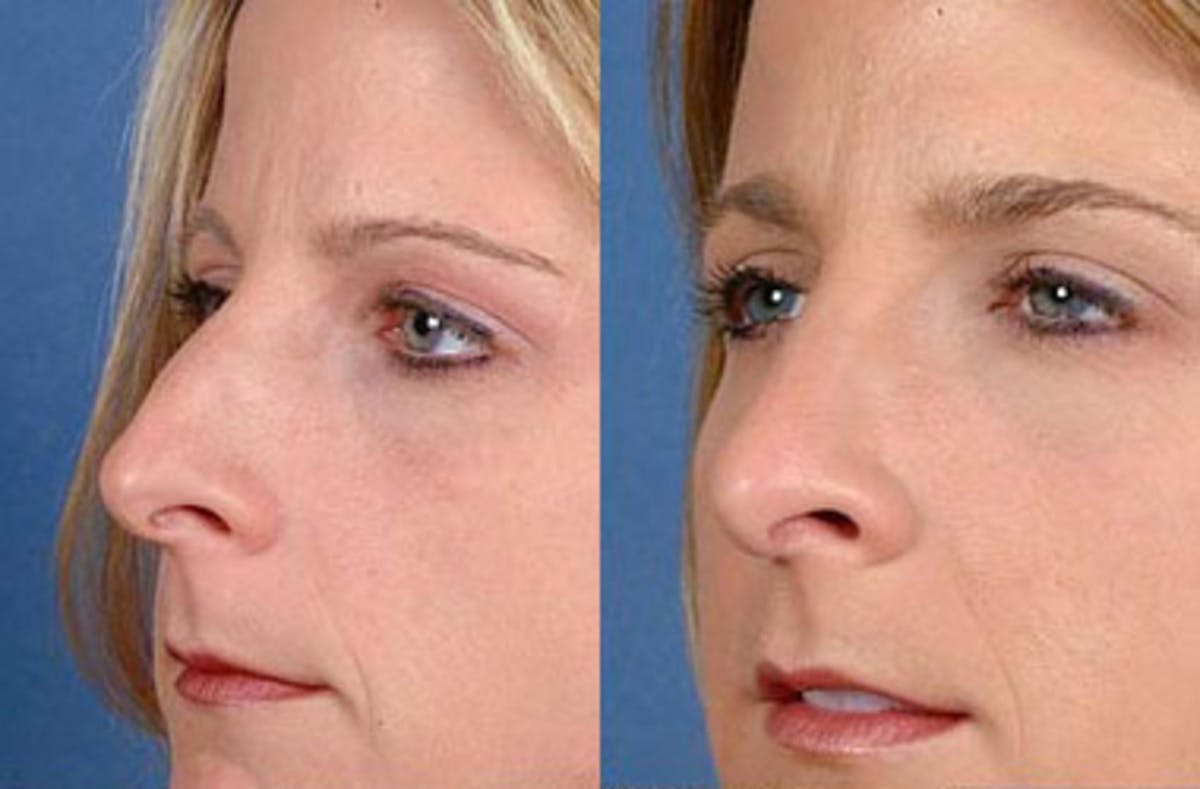 Nose Reshaping Before & After Gallery - Patient 233829 - Image 1