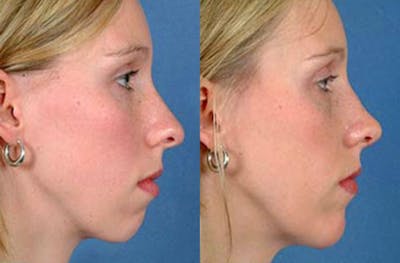 Nose Reshaping Before & After Gallery - Patient 249951 - Image 1