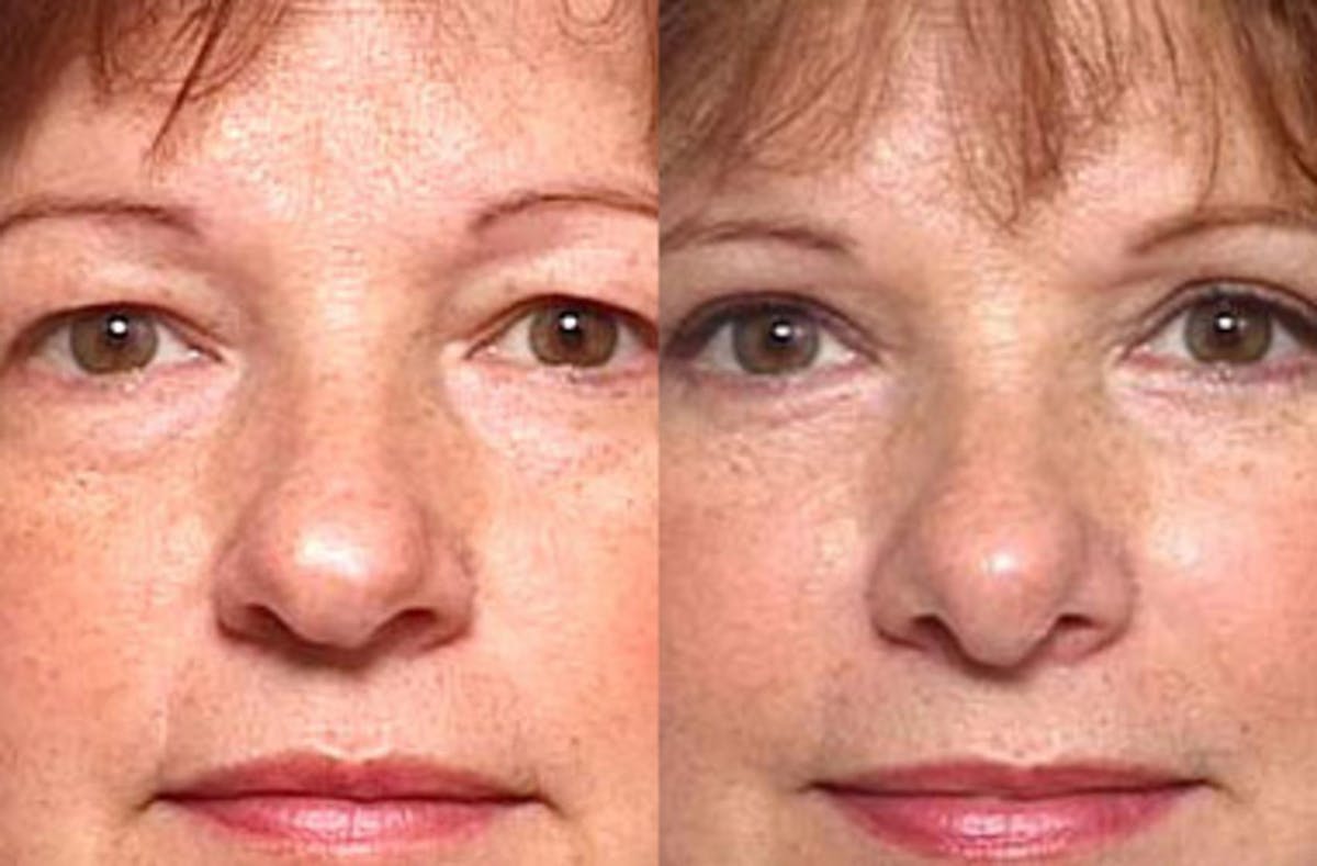 Nose Reshaping Before & After Gallery - Patient 379827 - Image 1