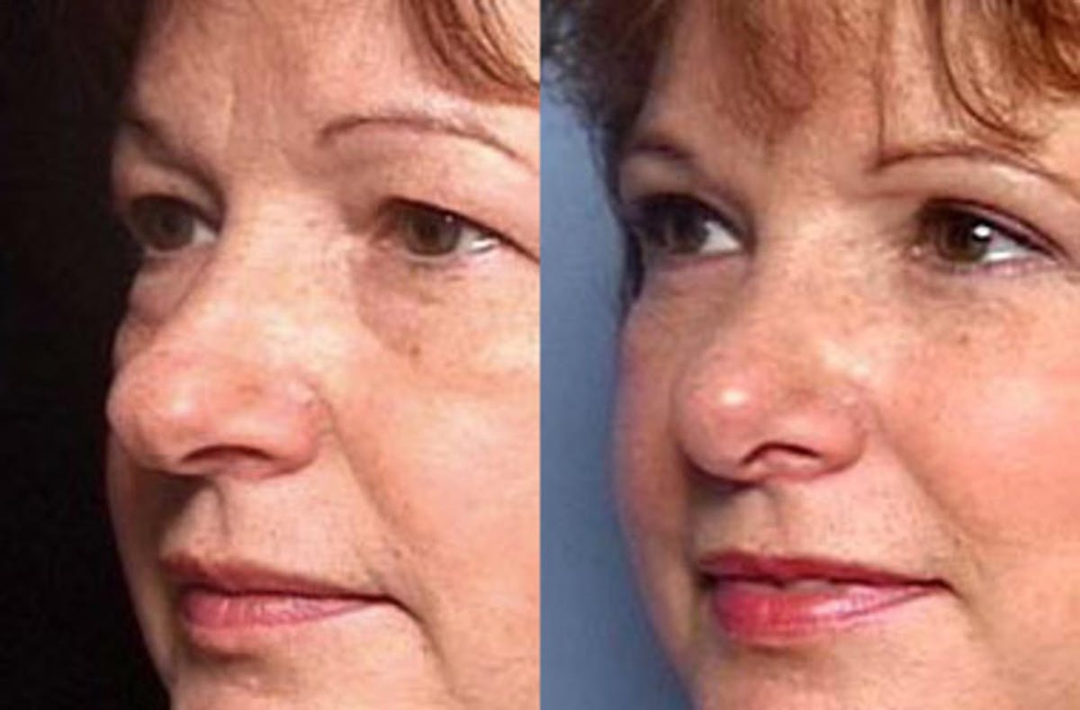 Nose Reshaping Before & After Gallery - Patient 379827 - Image 2