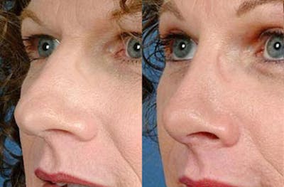 Nose Reshaping Before & After Gallery - Patient 112556 - Image 1