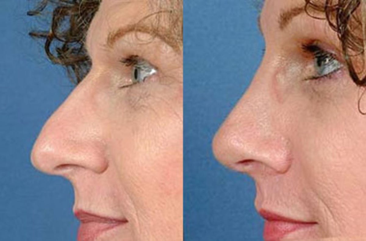 Nose Reshaping Before & After Gallery - Patient 112556 - Image 2