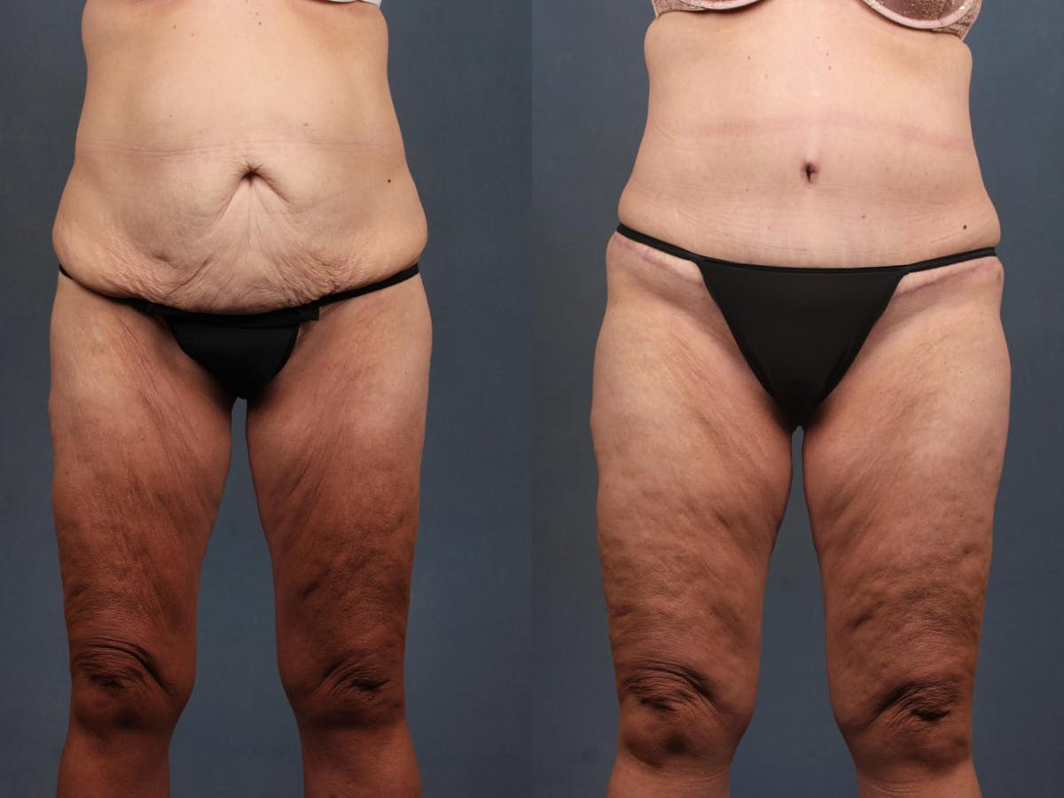 Tummy Tuck Before & After Gallery - Patient 823060 - Image 1