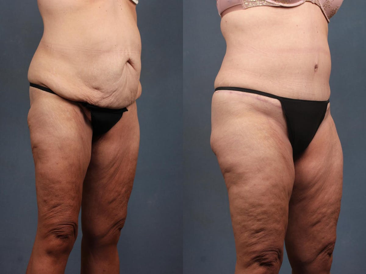 Tummy Tuck Before & After Gallery - Patient 823060 - Image 3