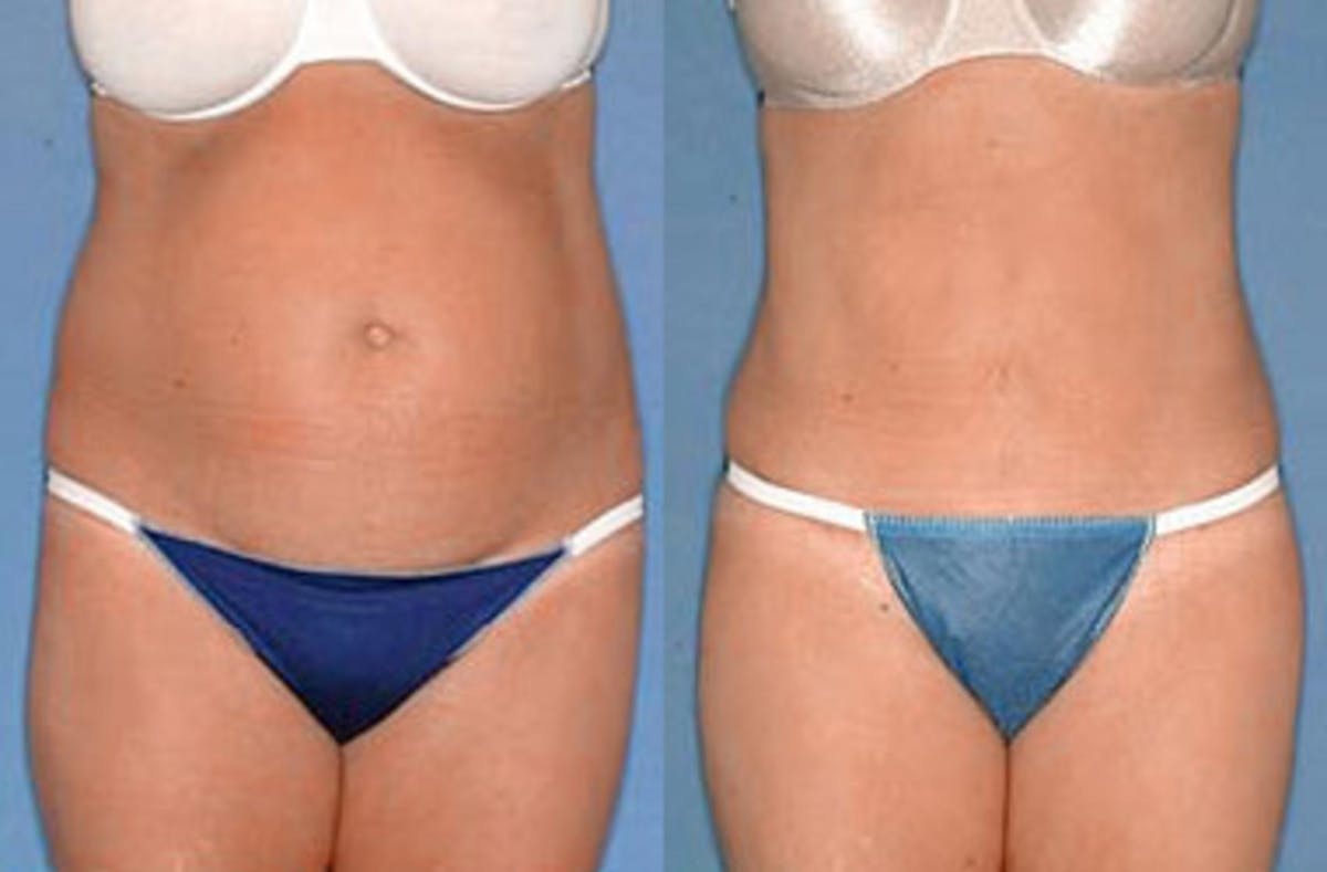 Tummy Tuck Before & After Gallery - Patient 192531 - Image 1