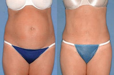 Tummy Tuck Before & After Gallery - Patient 192531 - Image 1
