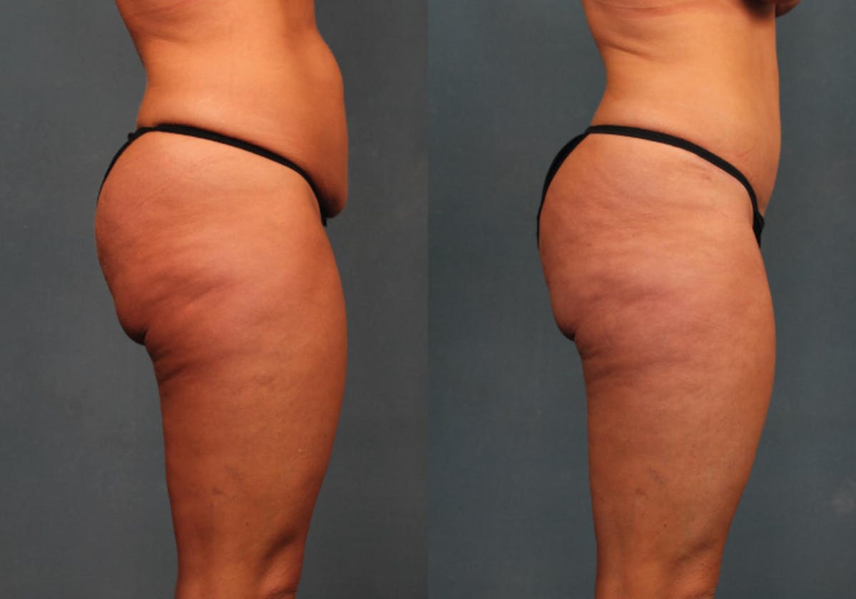 Tummy Tuck Before & After Gallery - Patient 225659 - Image 2