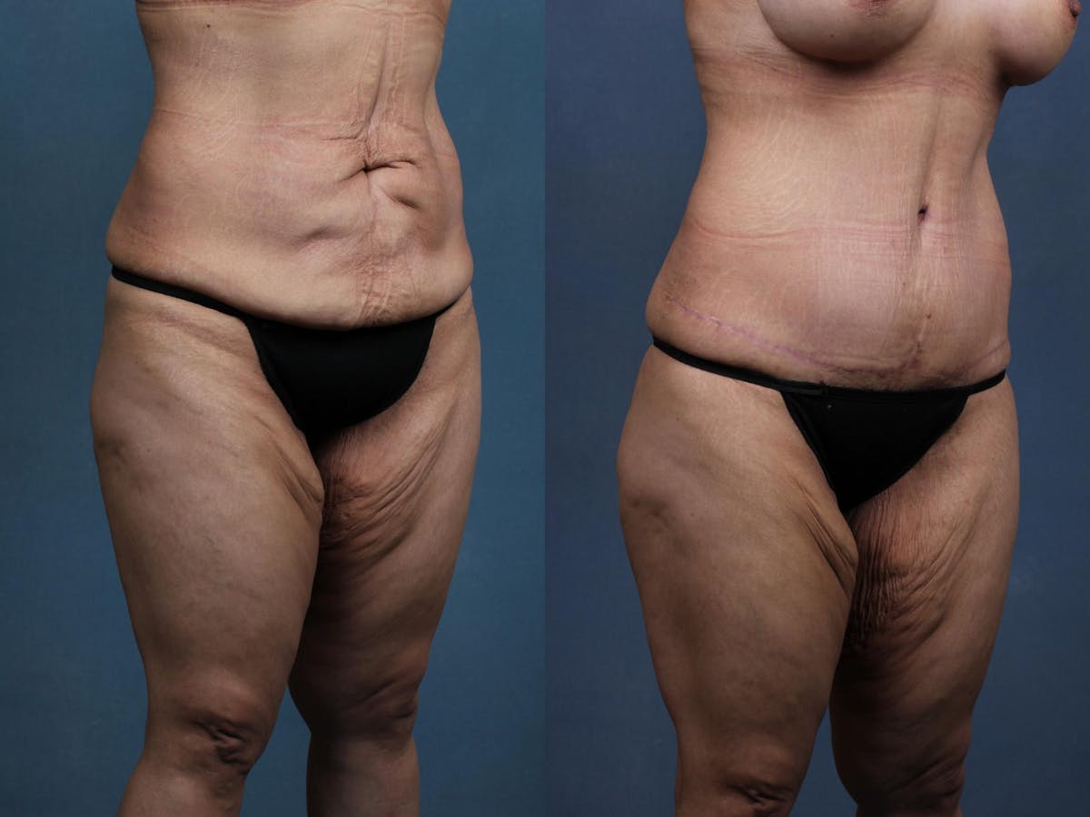 Tummy Tuck Before & After Gallery - Patient 408685 - Image 2