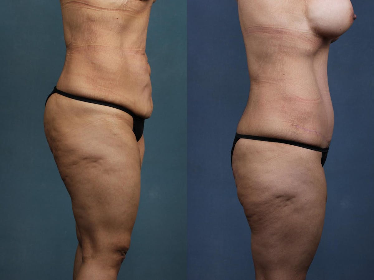 Tummy Tuck Before & After Gallery - Patient 408685 - Image 3