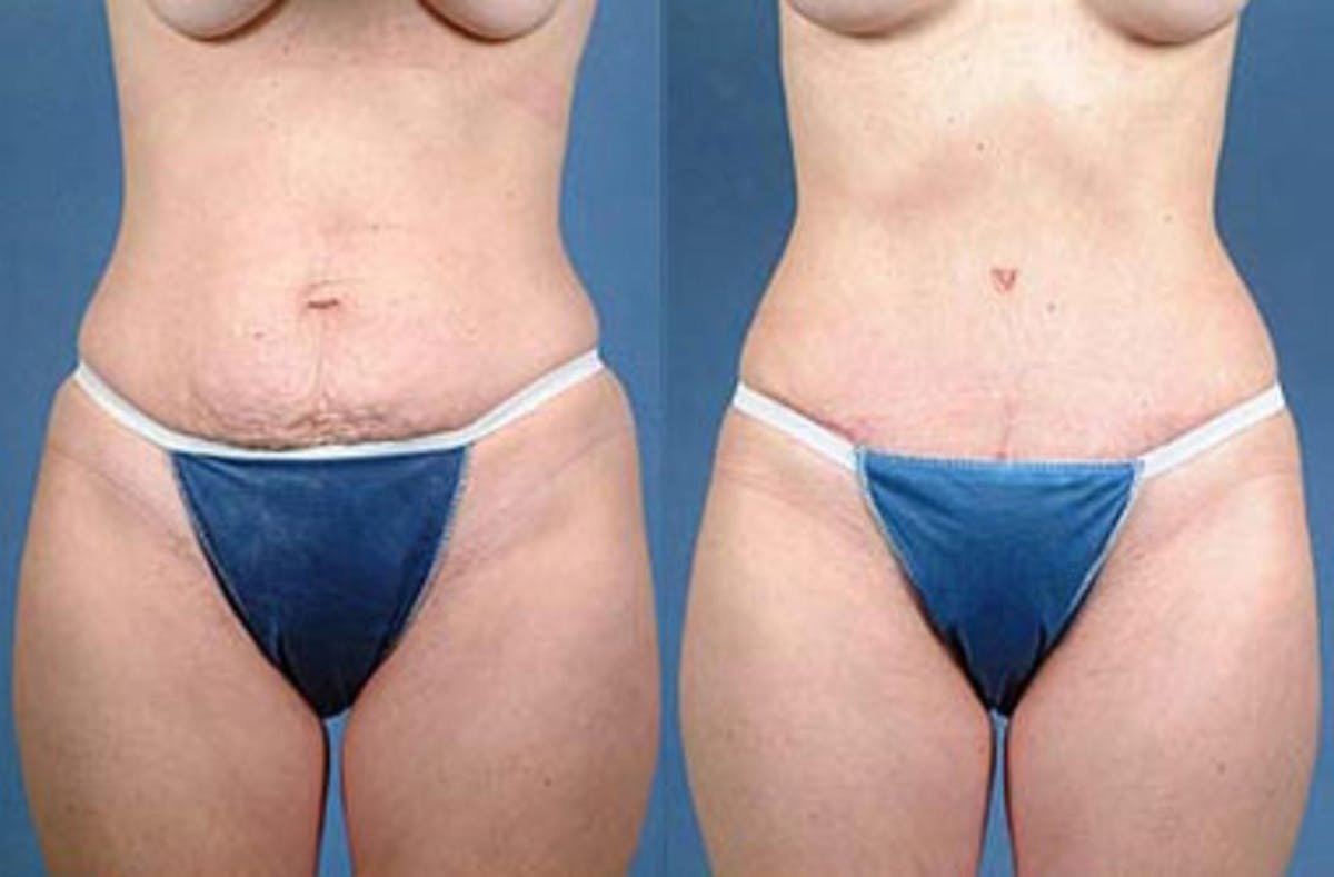 Tummy Tuck Before & After Gallery - Patient 314740 - Image 1