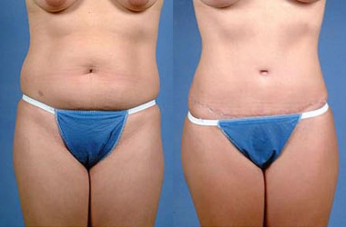 Tummy Tuck Before & After Gallery - Patient 139382 - Image 1