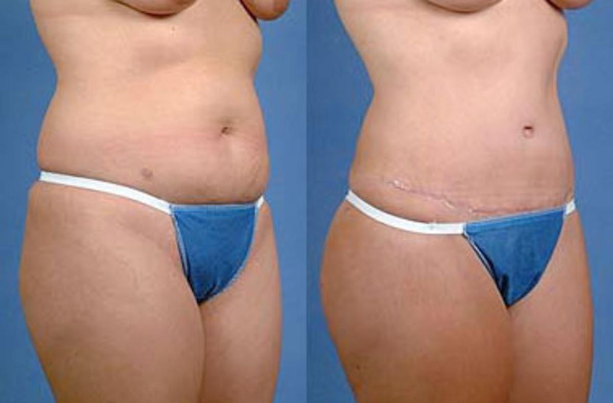 Tummy Tuck Before & After Gallery - Patient 139382 - Image 2