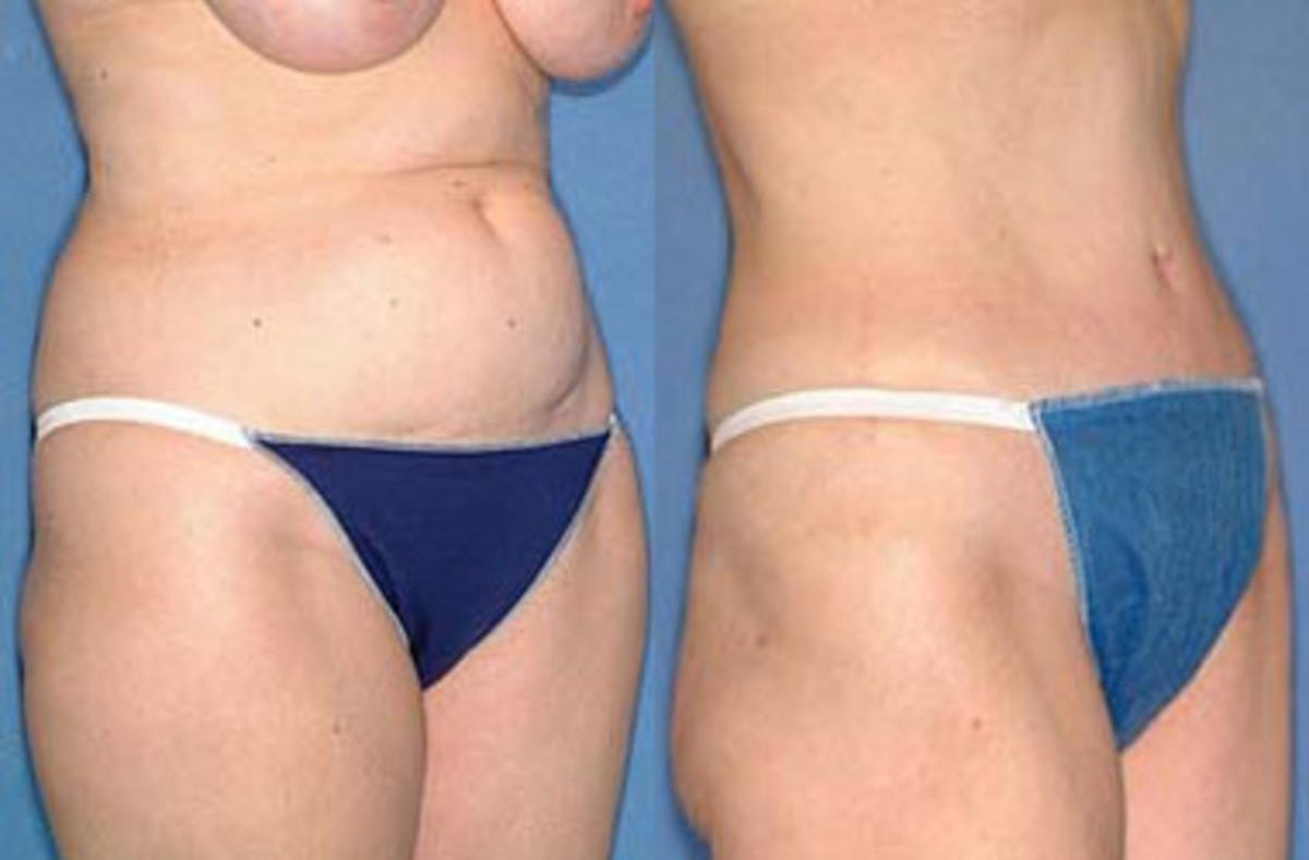 Tummy Tuck Before & After Gallery - Patient 767242 - Image 2