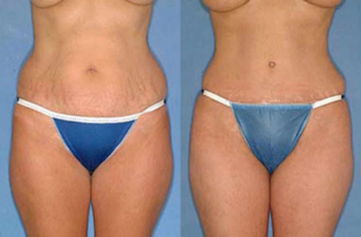 Tummy Tuck Before & After Gallery - Patient 631599 - Image 1
