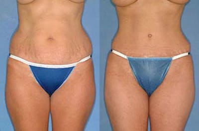 Tummy Tuck Before & After Gallery - Patient 631599 - Image 1