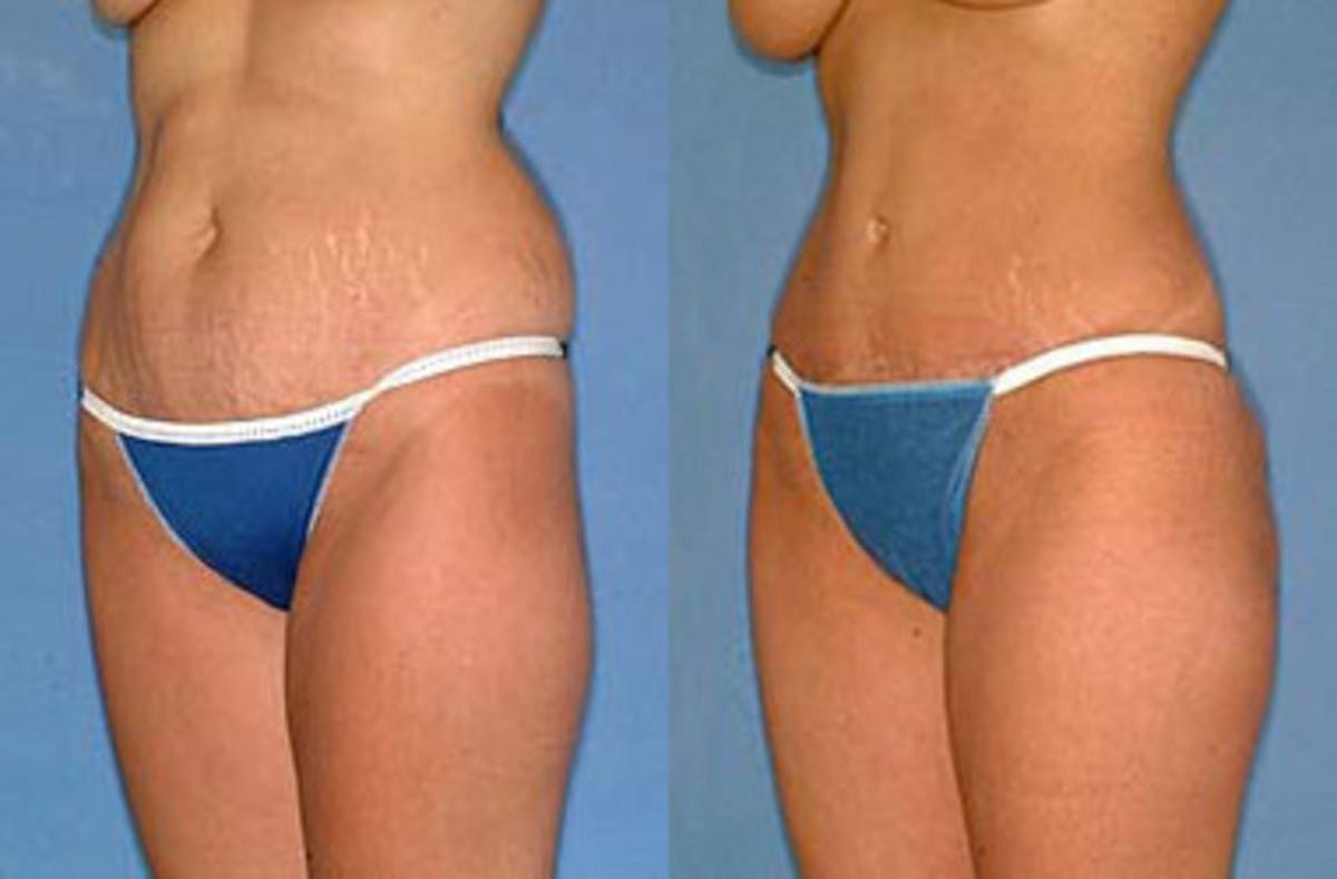 Tummy Tuck Before & After Gallery - Patient 631599 - Image 2