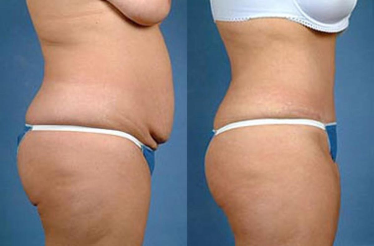 Tummy Tuck Before & After Gallery - Patient 162743 - Image 2