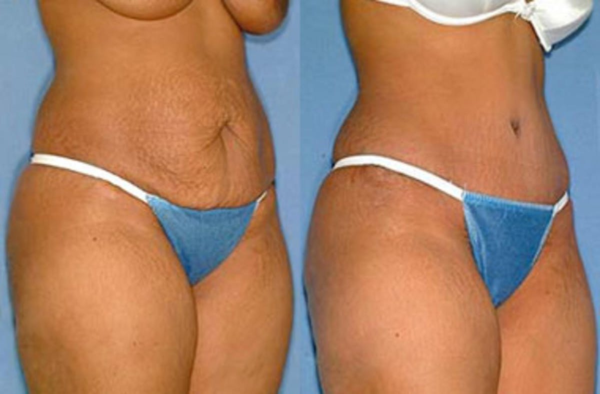 Tummy Tuck Before & After Gallery - Patient 522801 - Image 2