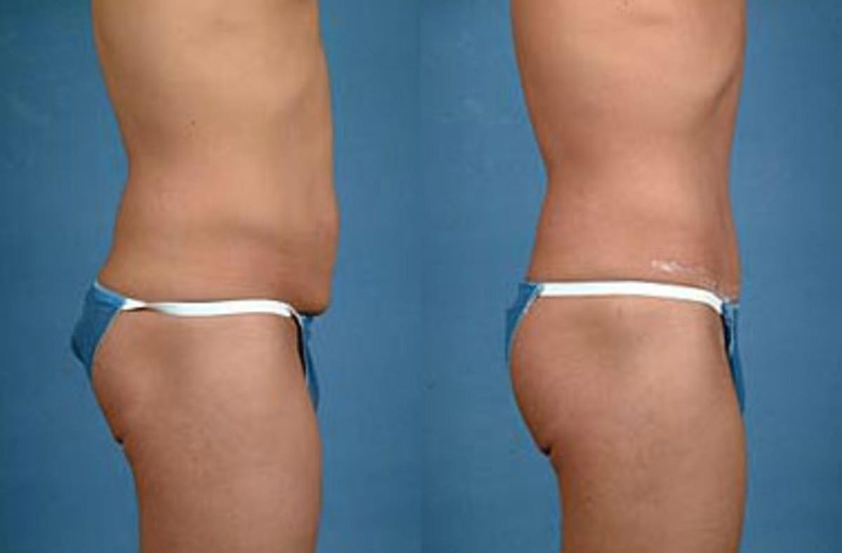 Tummy Tuck Before & After Gallery - Patient 425729 - Image 2