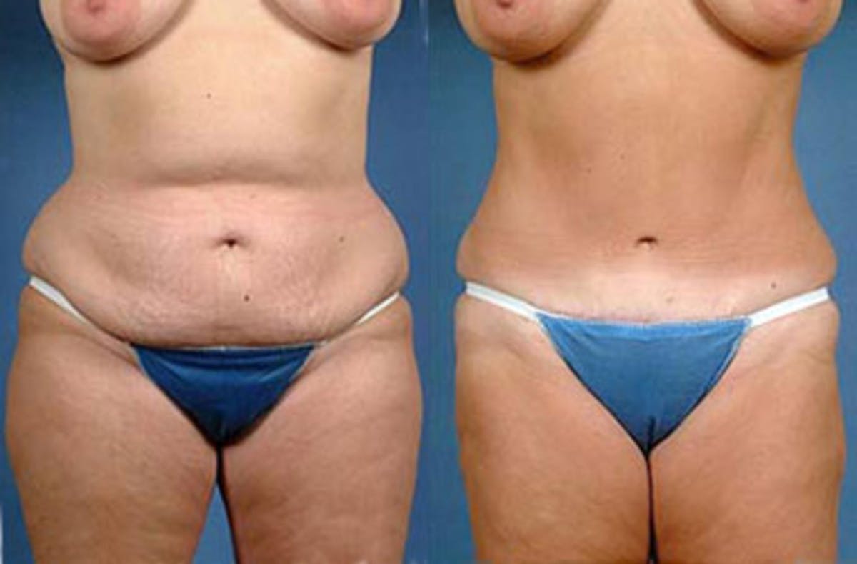 Tummy Tuck Before & After Gallery - Patient 246942 - Image 1