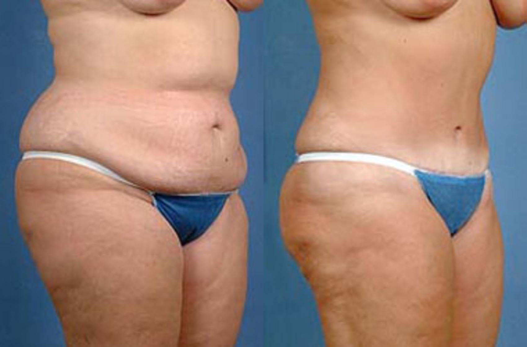tummy tuck results